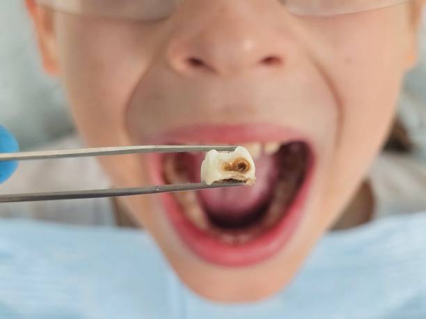 Best Emergency Dentist for Lost Fillings or Crowns in Blue Rapids, KS